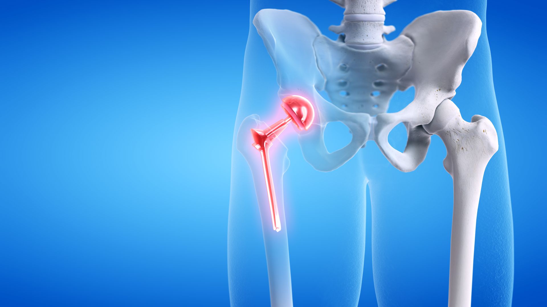 Hüftprothese Reha & Therapie Diagnoselexikon Körperwerk Südbaden